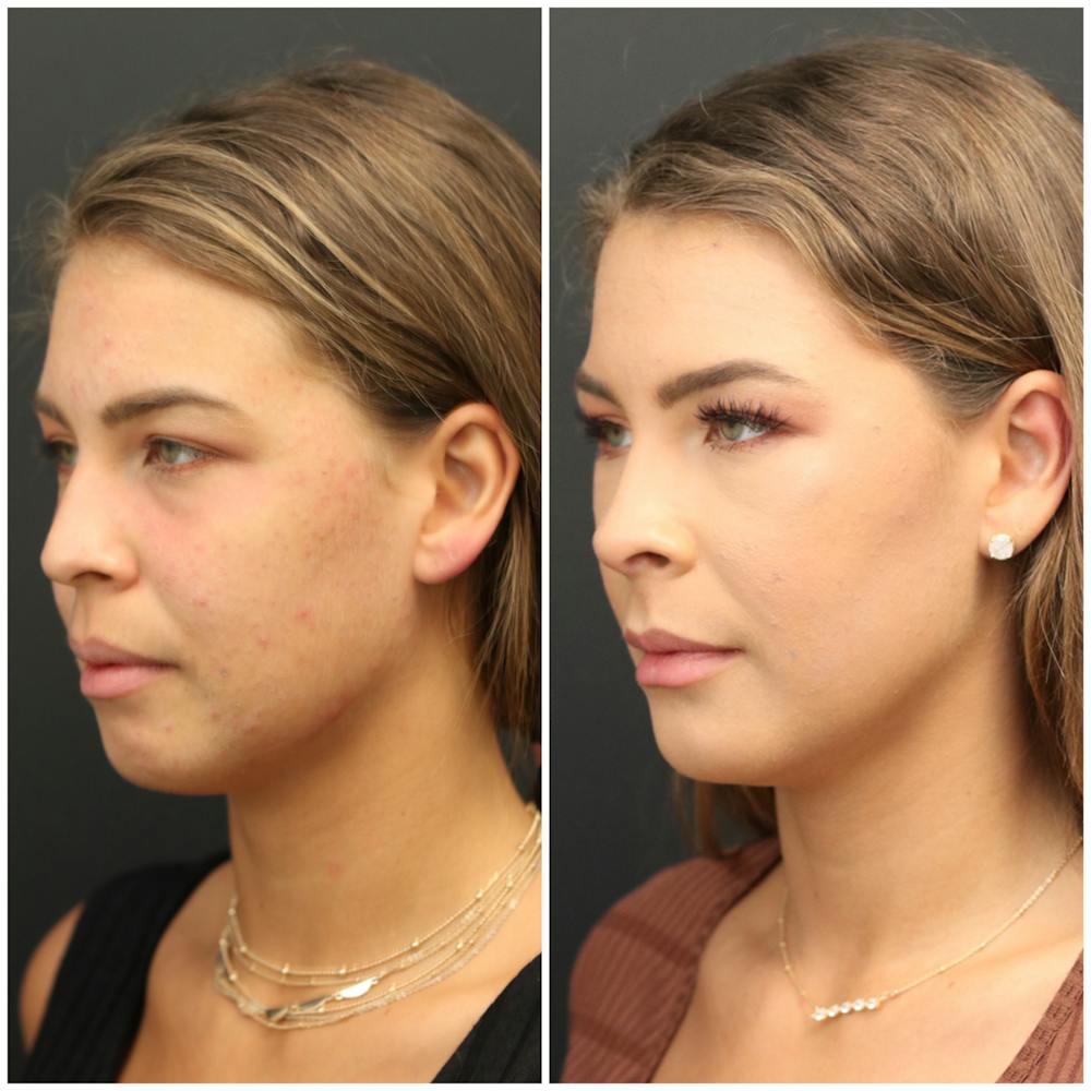 Aesthetic Facial Balancing Before & After Gallery - Patient 11681596 - Image 2