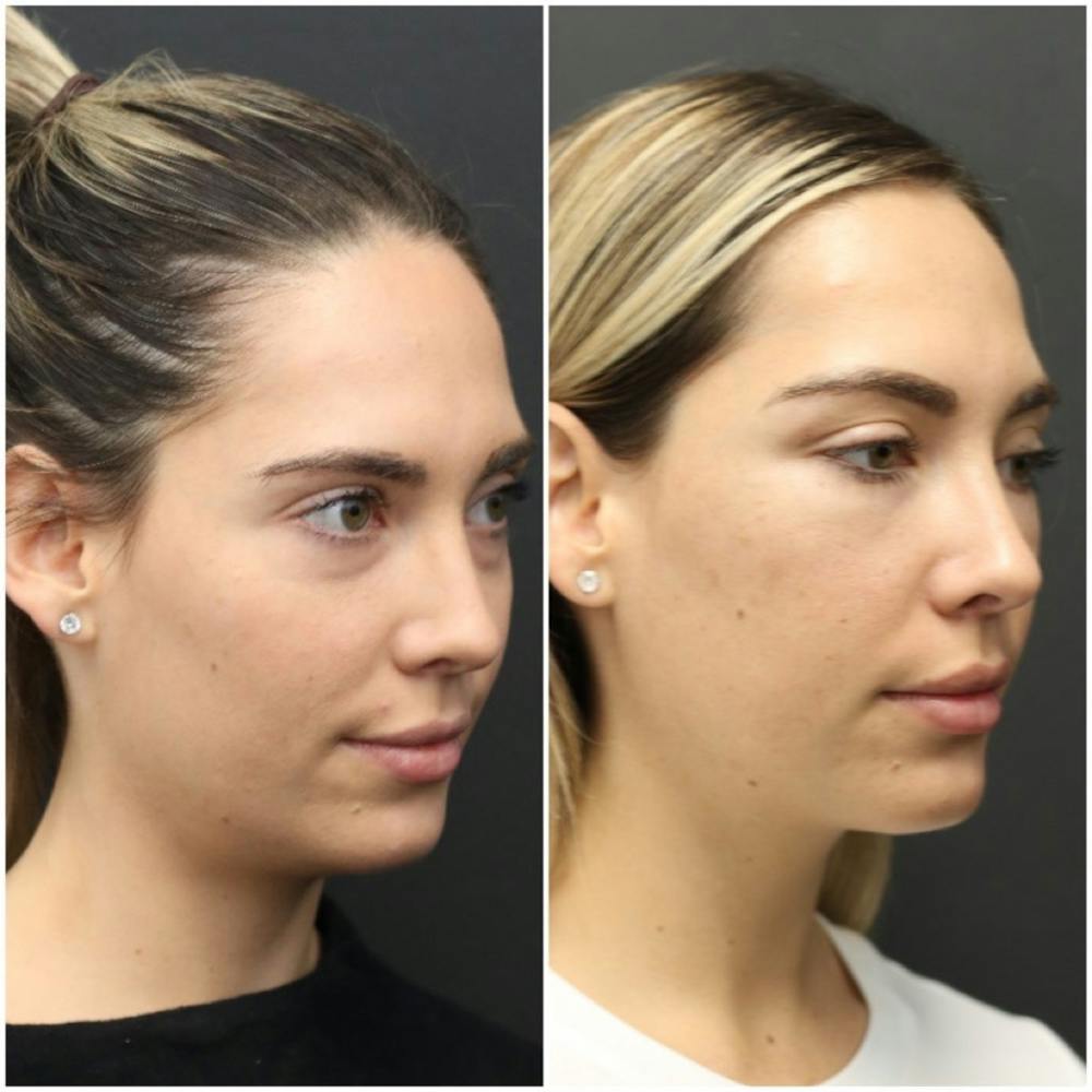 Aesthetic Facial Balancing Before & After Gallery - Patient 11681599 - Image 2