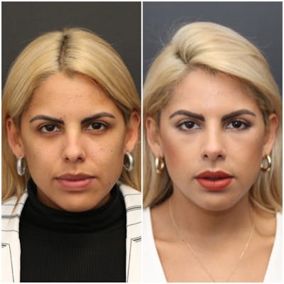 Aesthetic Facial Balancing Before & After Gallery - Patient 11681600 - Image 1