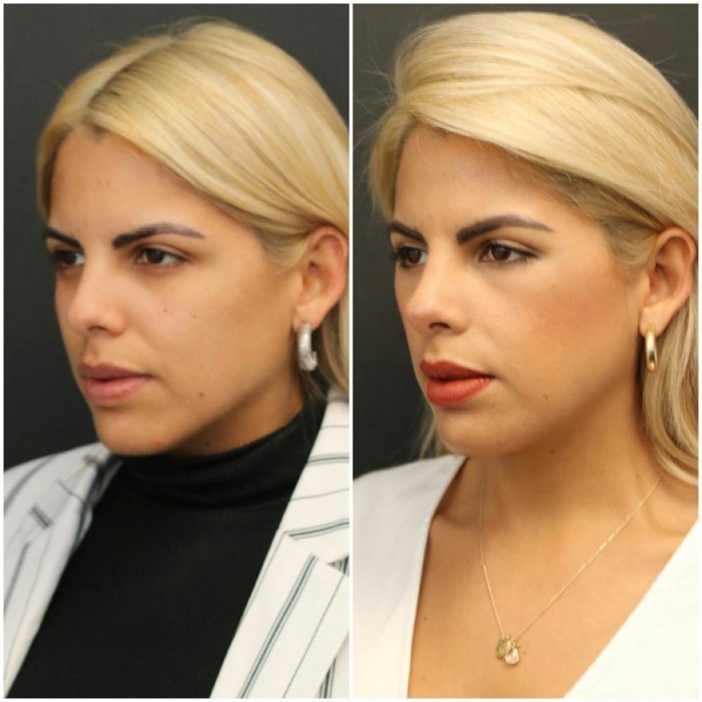 Aesthetic Facial Balancing Before & After Gallery - Patient 11681600 - Image 2