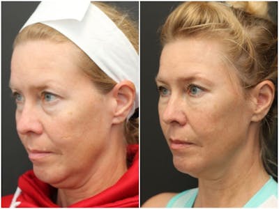 Aesthetic Facial Balancing Before & After Gallery - Patient 11681601 - Image 2