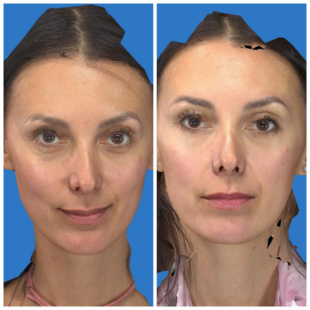 Aesthetic Facial Balancing Before & After Gallery - Patient 11681602 - Image 1