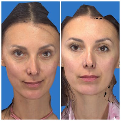 Aesthetic Facial Balancing Before & After Gallery - Patient 11681602 - Image 1