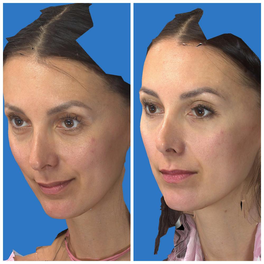 Aesthetic Facial Balancing Before & After Gallery - Patient 11681602 - Image 2