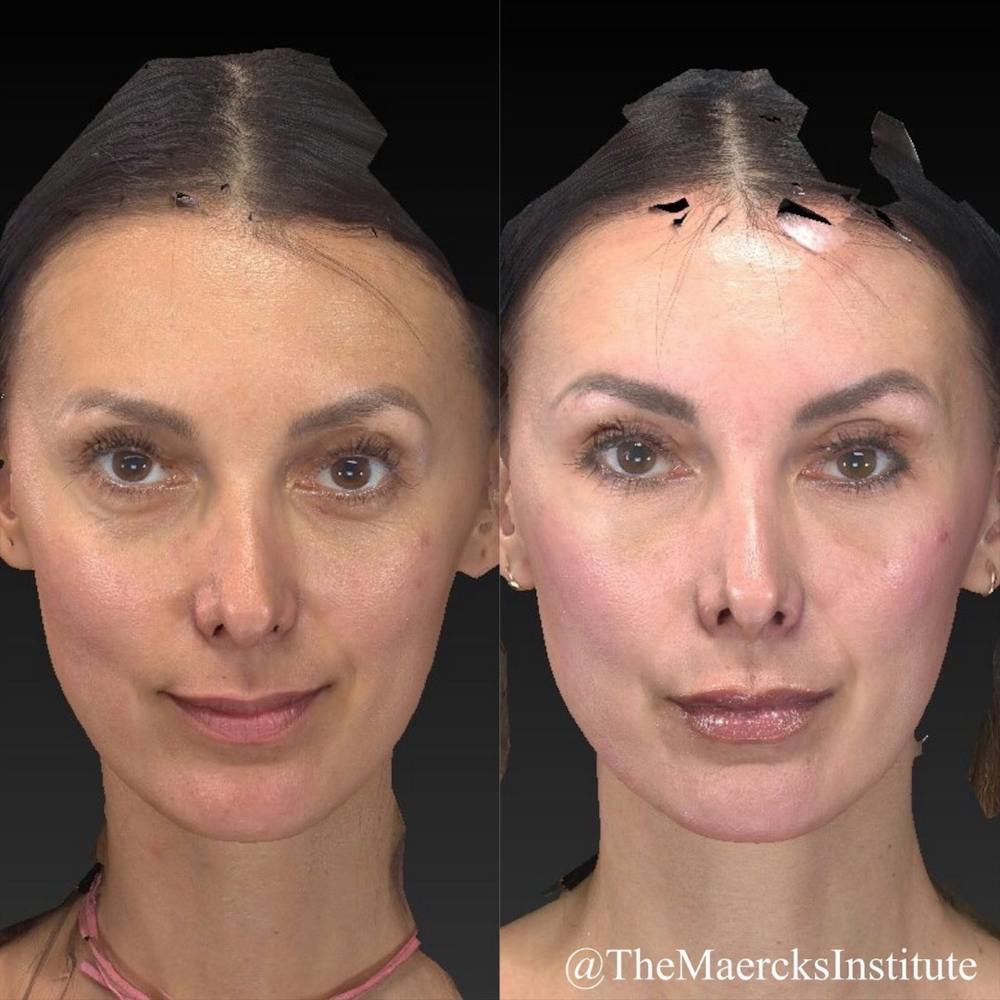 Aesthetic Facial Balancing Before & After Gallery - Patient 11681602 - Image 3