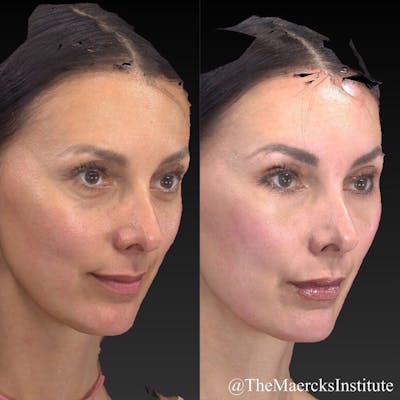 Aesthetic Facial Balancing Before & After Gallery - Patient 11681602 - Image 4