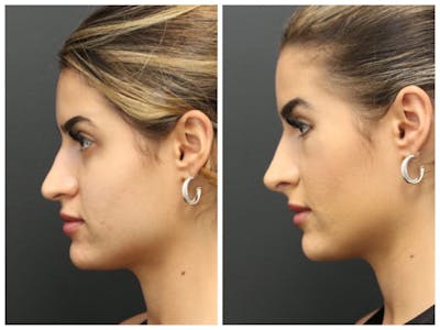 Aesthetic Facial Balancing Before & After Gallery - Patient 11681603 - Image 2