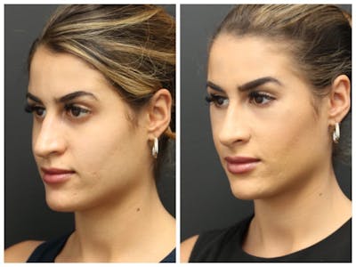 Aesthetic Facial Balancing Before & After Gallery - Patient 11681603 - Image 1