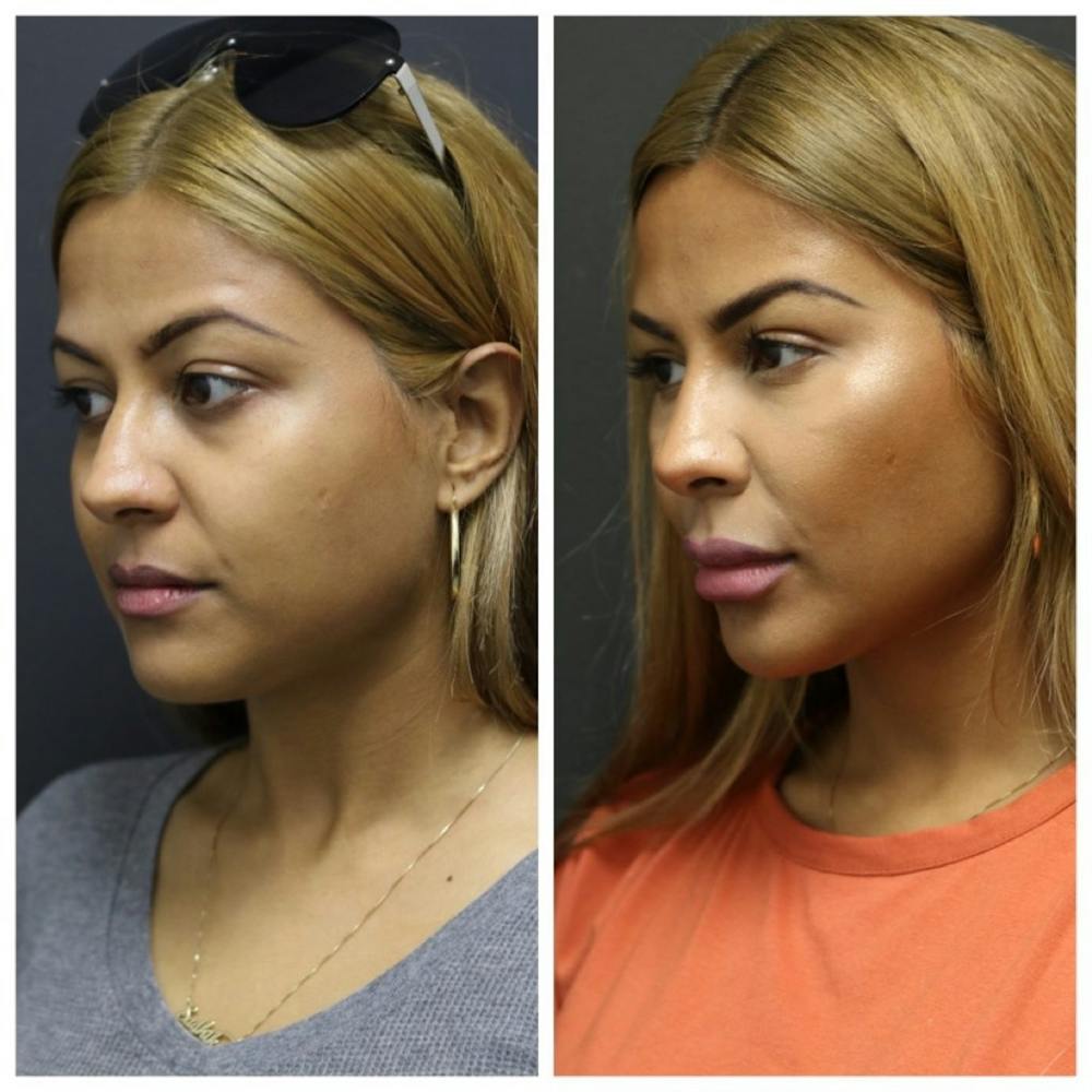 Aesthetic Facial Balancing Before & After Gallery - Patient 11681604 - Image 2