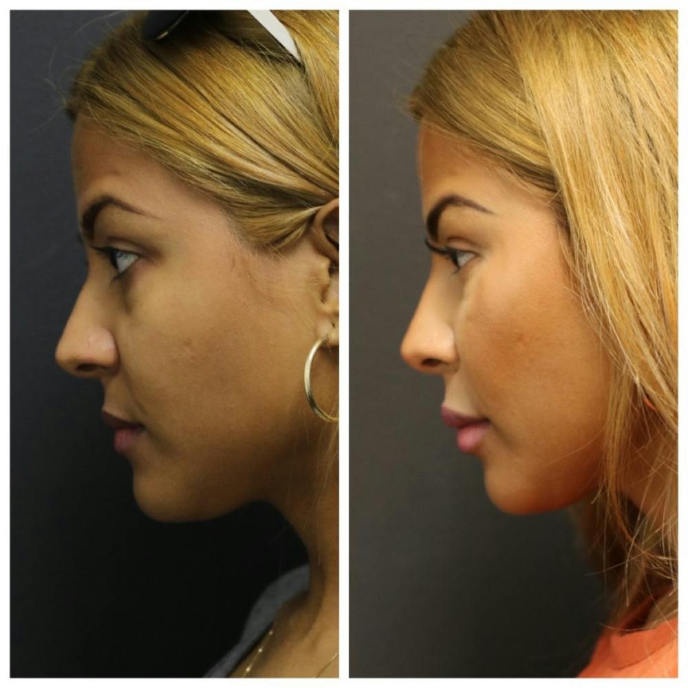 Aesthetic Facial Balancing Before & After Gallery - Patient 11681604 - Image 3