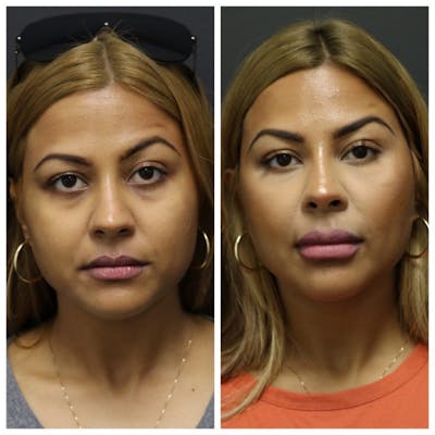 Aesthetic Facial Balancing Before & After Gallery - Patient 11681604 - Image 1