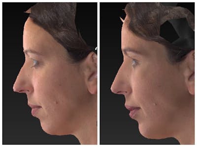 Aesthetic Facial Balancing Before & After Gallery - Patient 11681605 - Image 1