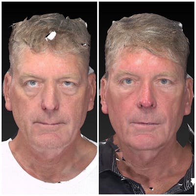 Aesthetic Facial Balancing Before & After Gallery - Patient 11681606 - Image 1
