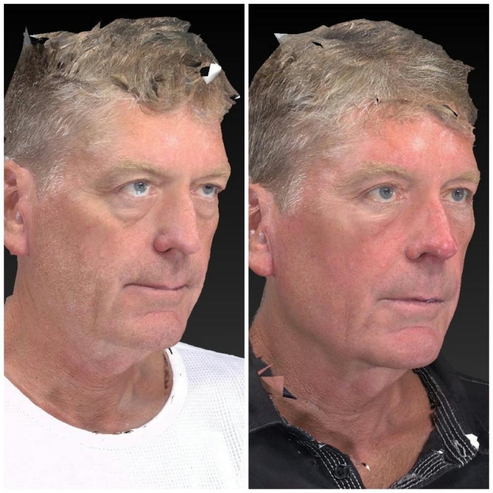 Aesthetic Facial Balancing Before & After Gallery - Patient 11681606 - Image 2