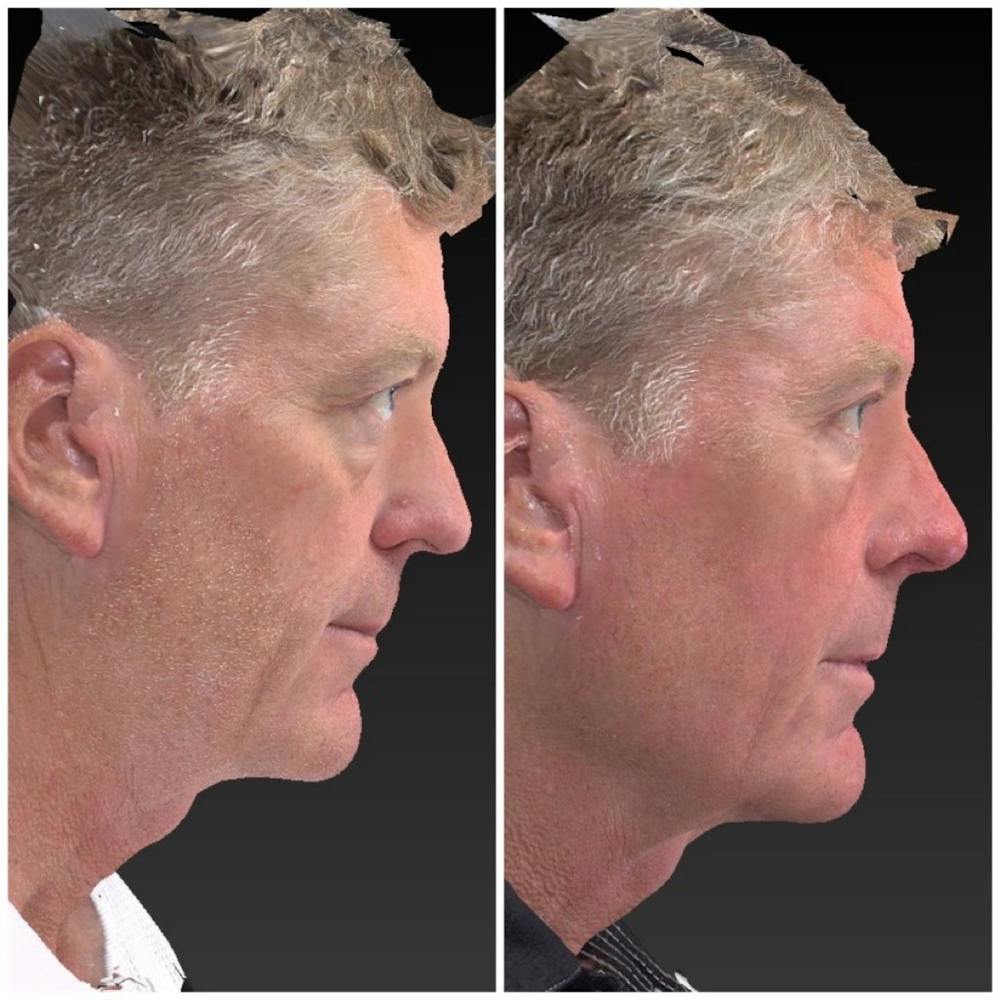 Aesthetic Facial Balancing Before & After Gallery - Patient 11681606 - Image 3