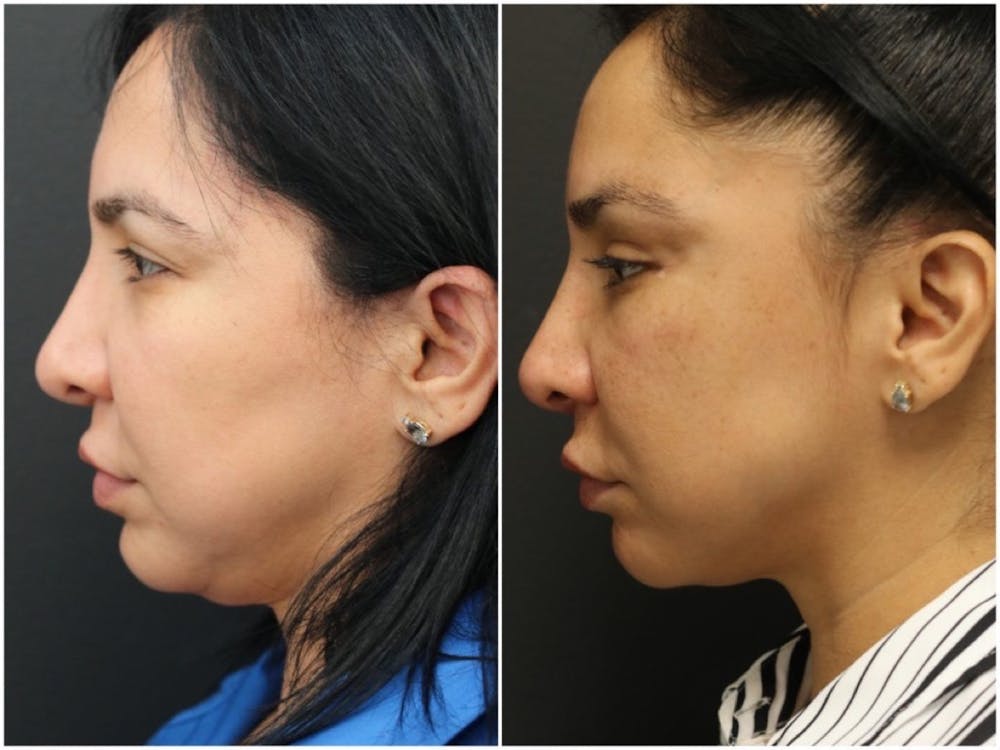 Aesthetic Facial Balancing Before & After Gallery - Patient 11681608 - Image 3