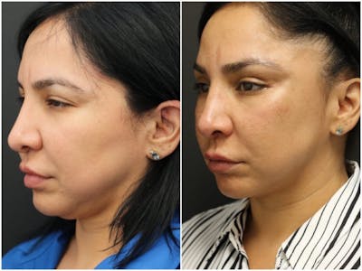 Aesthetic Facial Balancing Before & After Gallery - Patient 11681608 - Image 2
