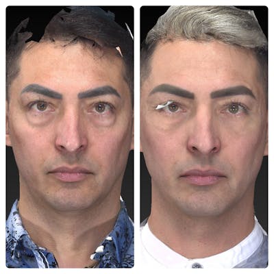 Aesthetic Facial Balancing Before & After Gallery - Patient 11681609 - Image 1