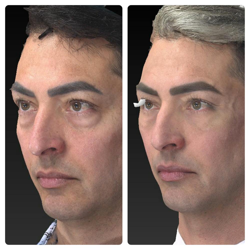 Aesthetic Facial Balancing Before & After Gallery - Patient 11681609 - Image 2