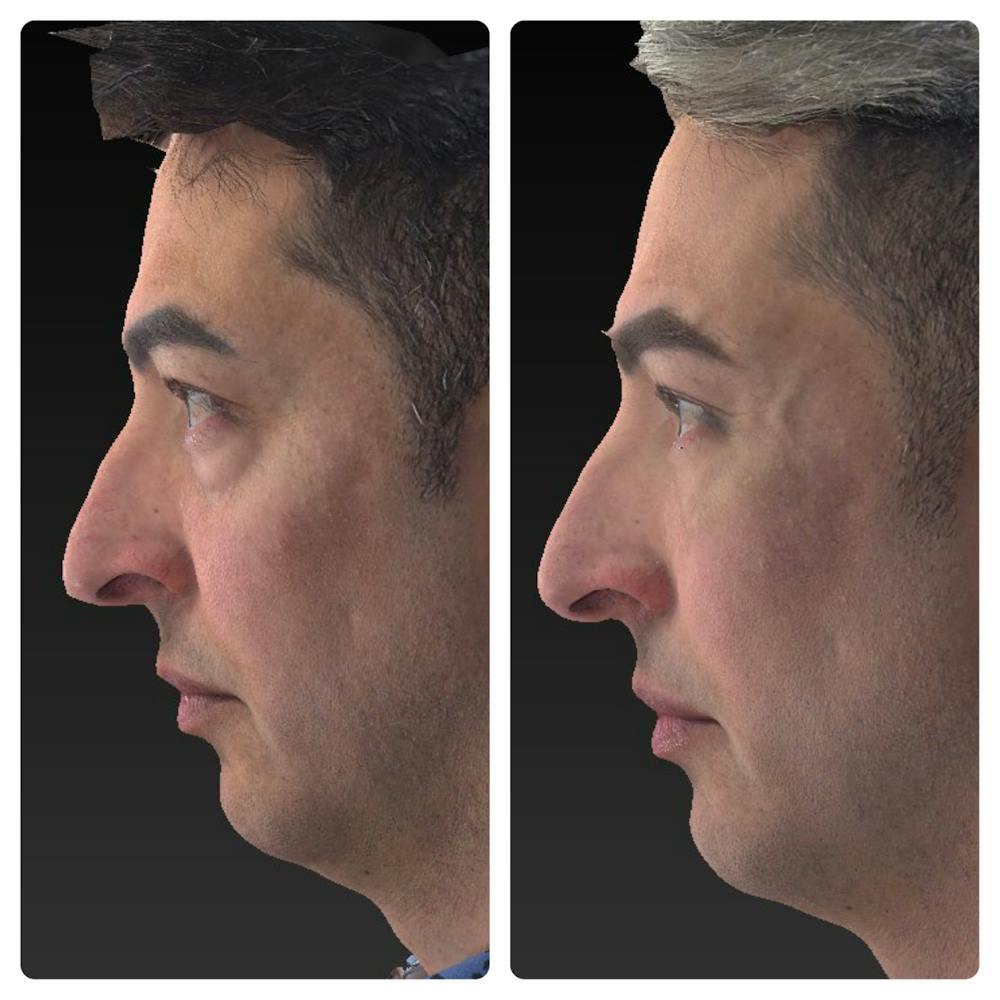 Aesthetic Facial Balancing Before & After Gallery - Patient 11681609 - Image 3