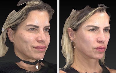 Aesthetic Facial Balancing Before & After Gallery - Patient 11681610 - Image 2