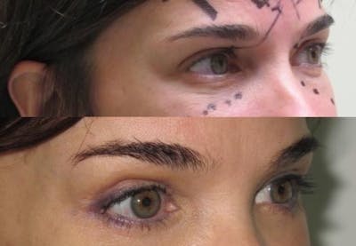 Eyelid Surgery Gallery - Patient 11681628 - Image 2