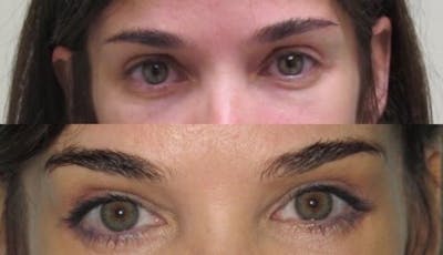 Eyelid Surgery Before & After Gallery - Patient 11681628 - Image 1