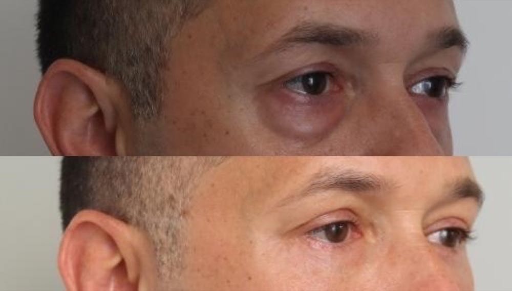 Eyelid Surgery Before & After Gallery - Patient 11681629 - Image 2