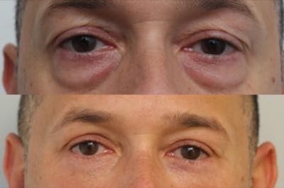 Eyelid Surgery Before & After Gallery - Patient 11681629 - Image 1