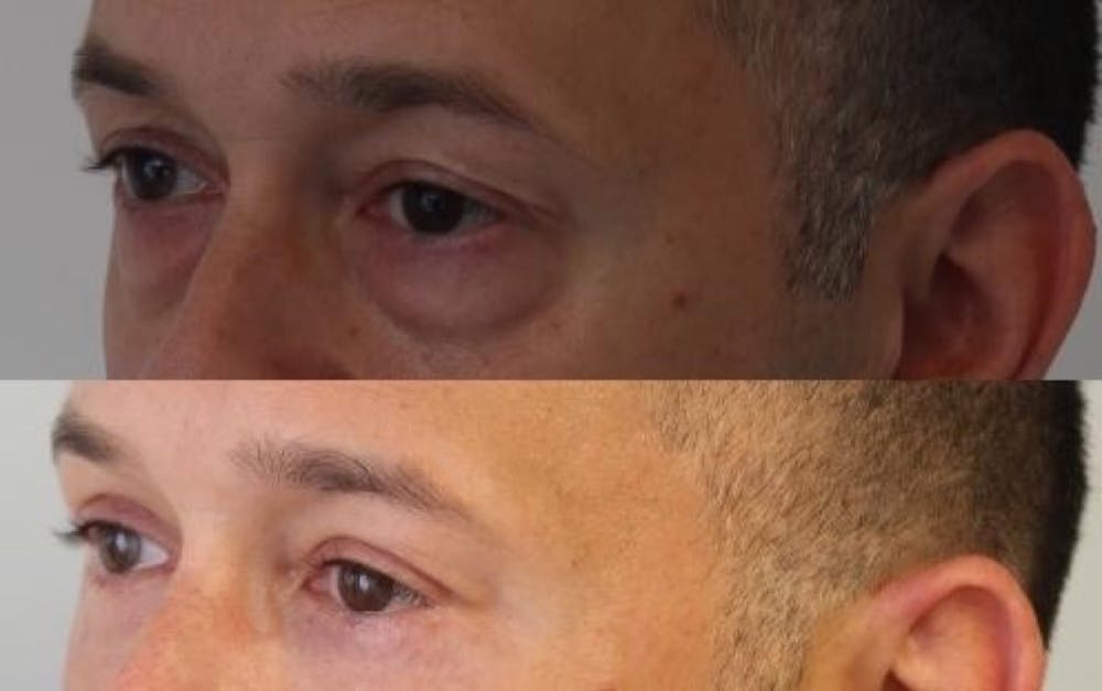 Eyelid Surgery Gallery - Patient 11681629 - Image 3