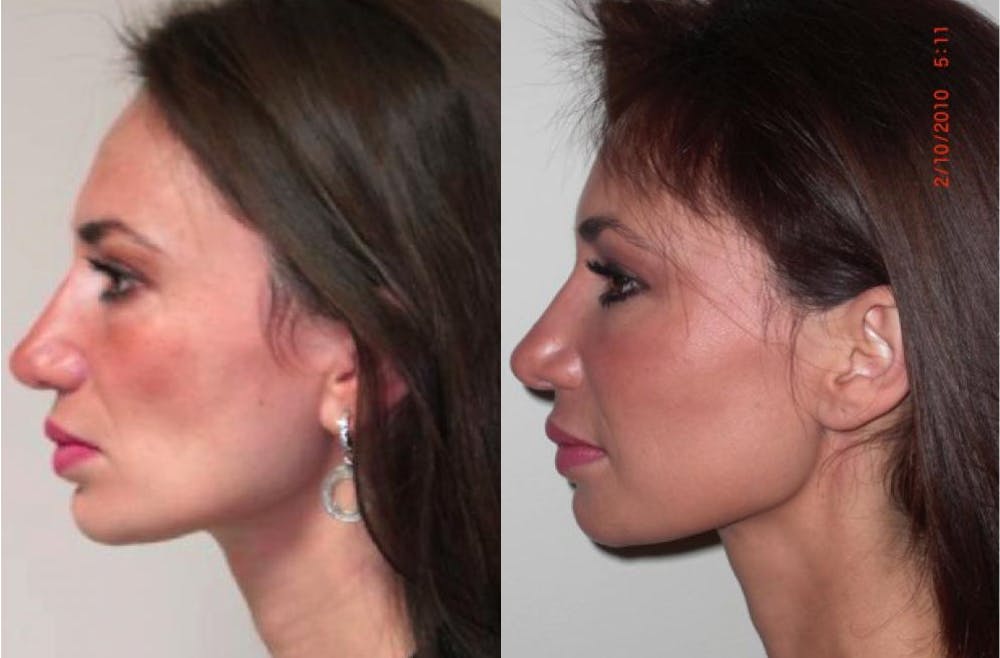 Fat Grafting Before & After Gallery - Patient 11681644 - Image 3