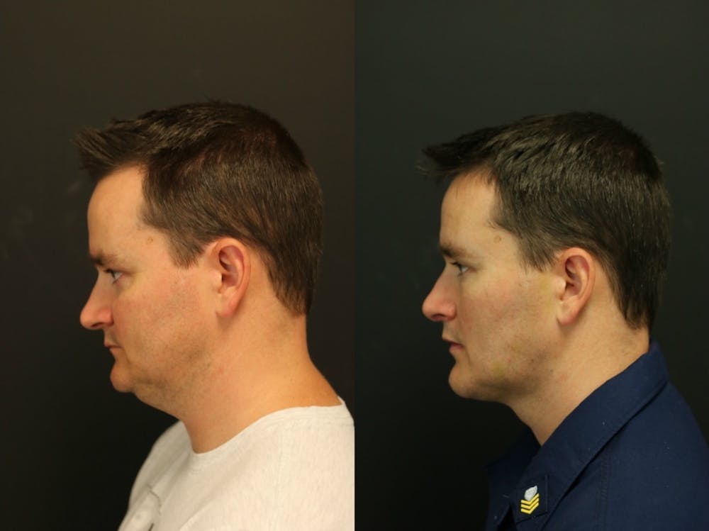 Fat Grafting Before & After Gallery - Patient 11681645 - Image 3