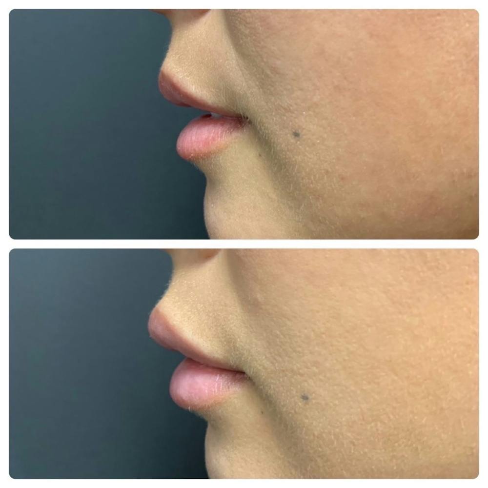Lip Augmentation Before & After Gallery - Patient 11681654 - Image 2