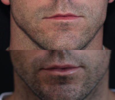 Lip Augmentation Before & After Gallery - Patient 11681655 - Image 1