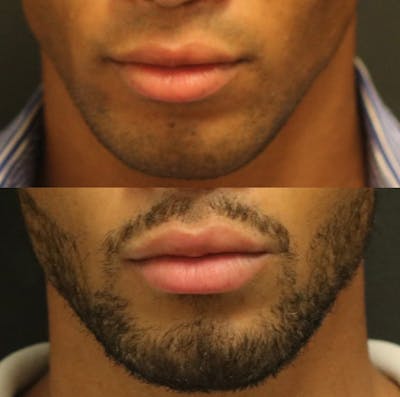 Lip Augmentation Before & After Gallery - Patient 11681656 - Image 1
