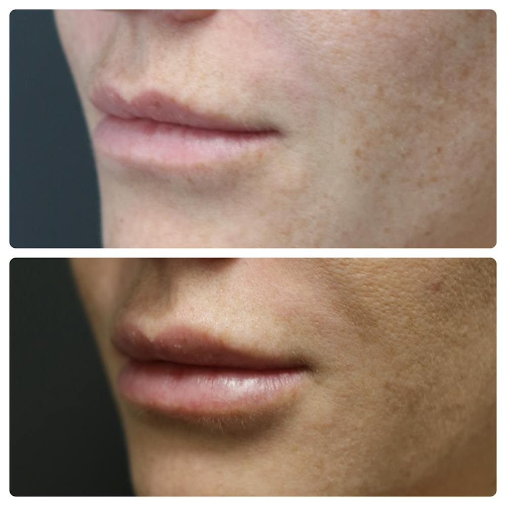 Lip Augmentation Before & After Gallery - Patient 11681658 - Image 1