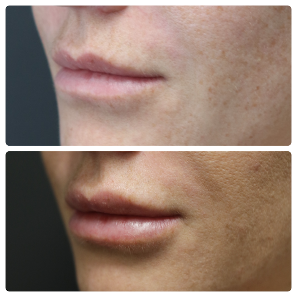 Lip Augmentation