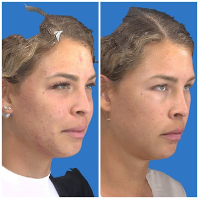 Photo Facial Before & After Gallery - Patient 11681661 - Image 2