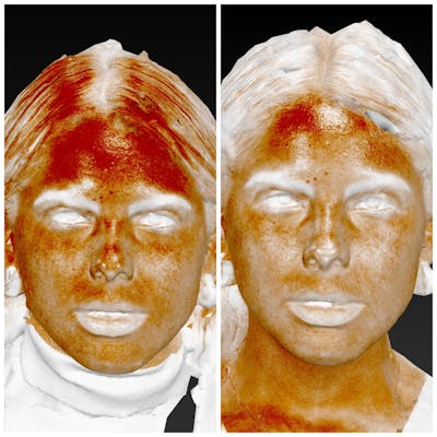 Photo Facial Before & After Gallery - Patient 11681662 - Image 1