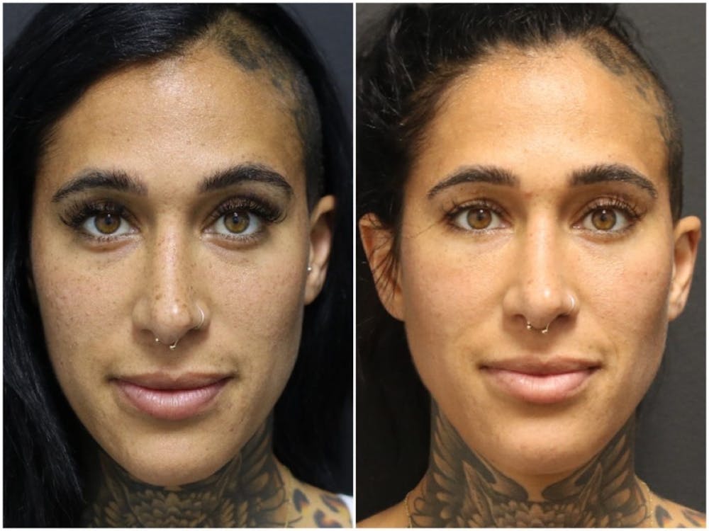Photo Facial Before & After Gallery - Patient 11681663 - Image 1