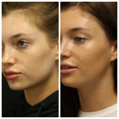 Photo Facial Before & After Gallery - Patient 11681664 - Image 2