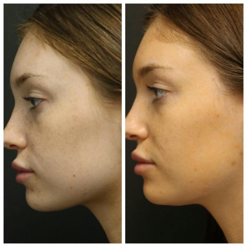 Photo Facial Before & After Gallery - Patient 11681664 - Image 3