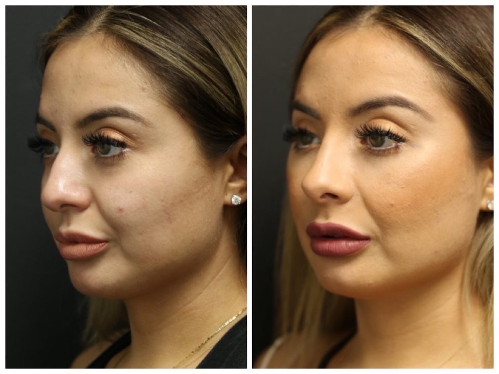 Rhinoplasty