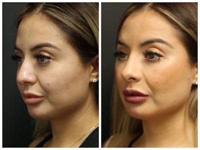Rhinoplasty Before & After Gallery - Patient 11681677 - Image 1