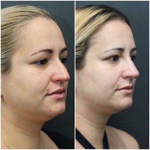 Rhinoplasty