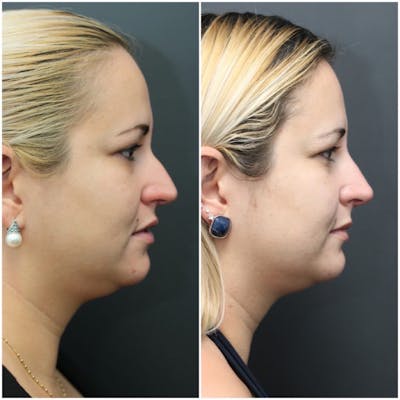 Rhinoplasty Before & After Gallery - Patient 11681678 - Image 2