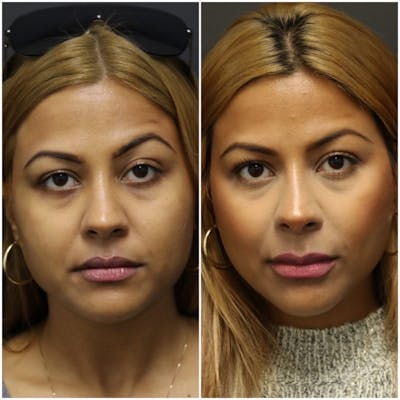 Rhinoplasty Before & After Gallery - Patient 11681681 - Image 1