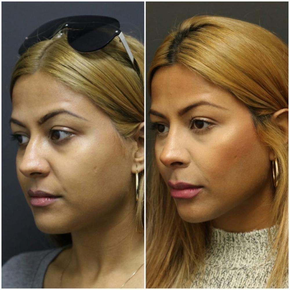 Rhinoplasty Before & After Gallery - Patient 11681681 - Image 2
