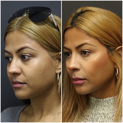 Rhinoplasty Before & After Gallery - Patient 11681681 - Image 2