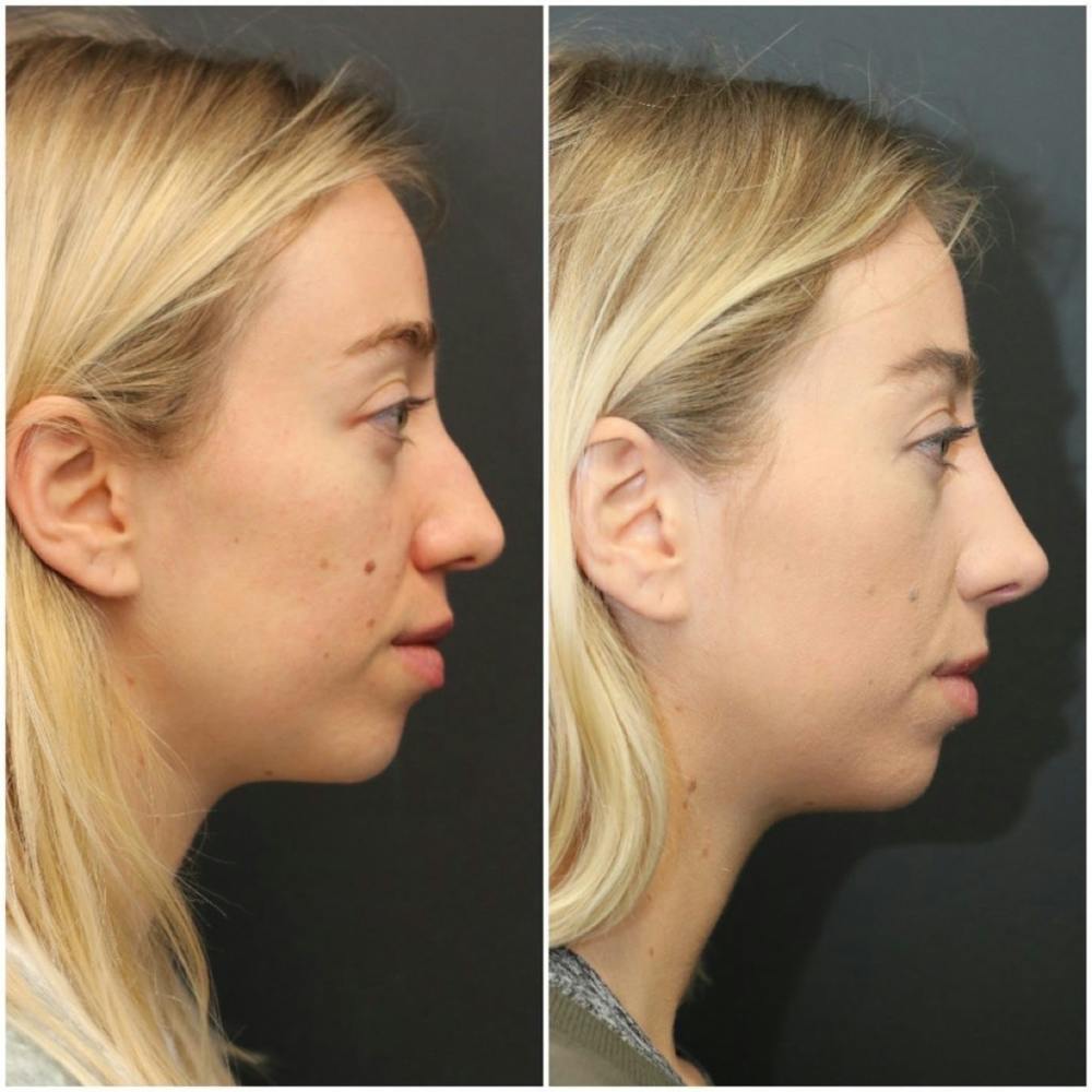 Rhinoplasty Before & After Gallery - Patient 11681682 - Image 2